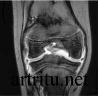 МРТ при диагностике артритов