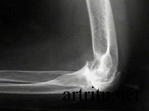 Рентген локтевого артрита