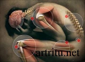 Классификация заболеваний суставов: артриты