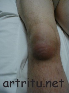 Бурситы в области коленного сустава