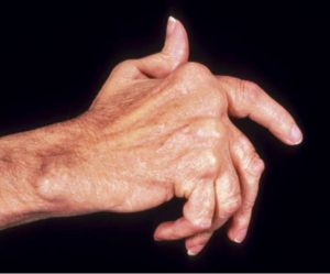 Осложнения ревматоидного артрита: виды, диагностика, лечение