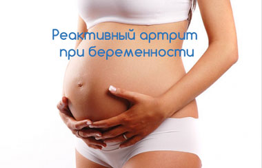 Реактивный артрит при беременности