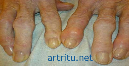 Виды артрита: подагрический артрит