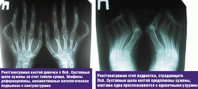 диагностика рентгеном псориатического артрита у детей