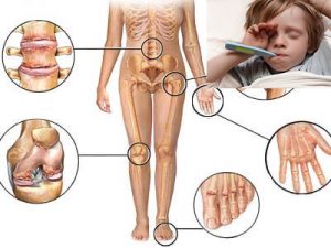 Основные причины инфекционного артрита у детей