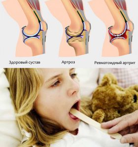 прогноз поствакцинального артрита у детей