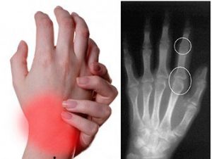 рентгенография реактивного артрита у детей