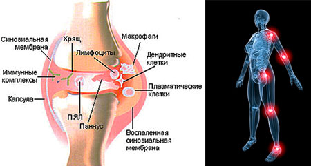 Симптомы ювенильного ревматоидного артрита
