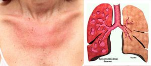 Последствия ювенильного ревматоидного артрита - Аллергосептичесий синдром