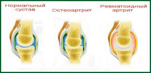 Суставная форма ювенильного ревматоидного артрита