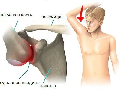 импинджмент синдром плечевого сустава