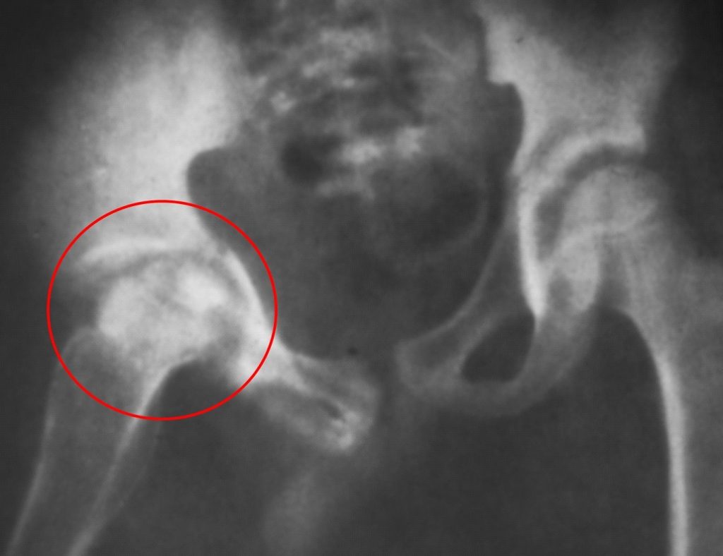 рентген-исследование поражённого сустава