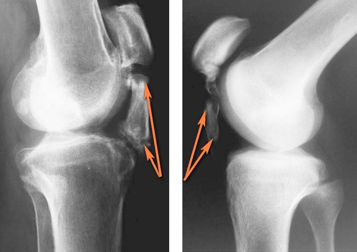 Что такое лигаментоз коленного сустава, как лечить и предупреждать 