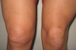 отёчность колена при хондроматозе