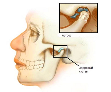 Признаки артроза лицевого сустава