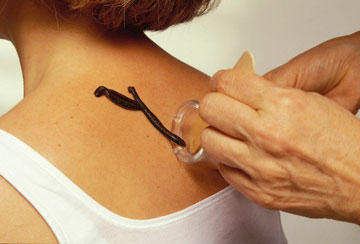 Гирудотерапия плечевого периартрита