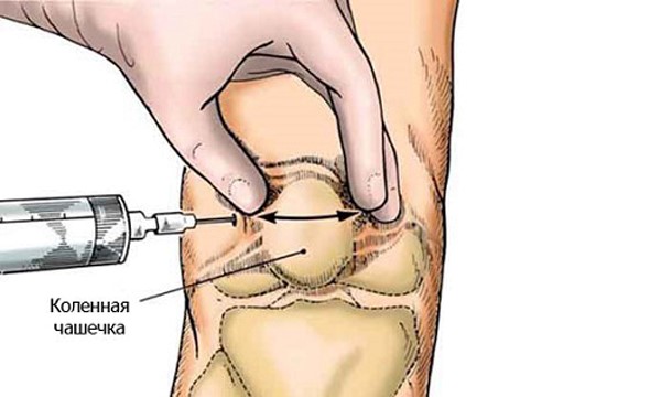 Как правильно делать укол в колено