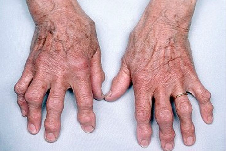 Причины болезненности суставов пальцев рук