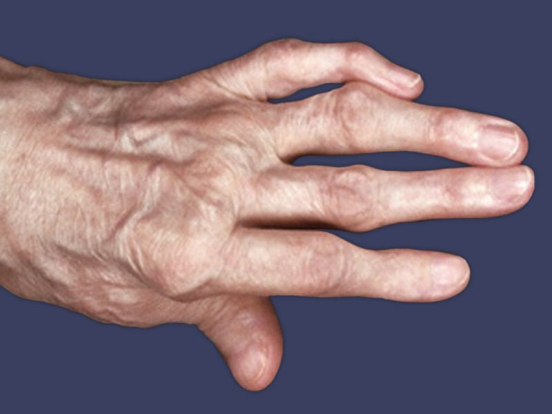 Методы лечения артрита рук