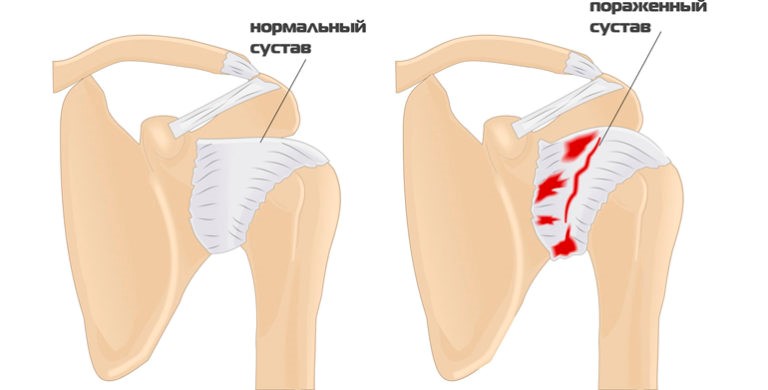 Признаки остеоартроза плечевого сустава