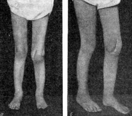 Туберкулезное поражение коленного сустава