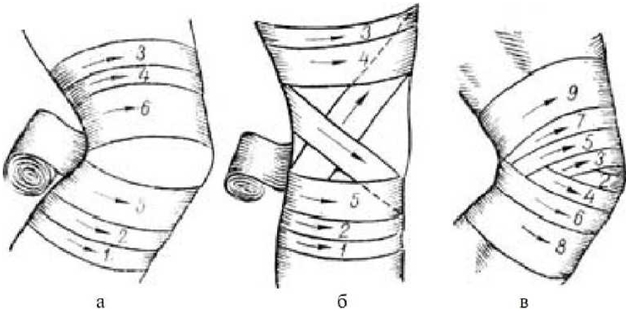Наложение расходящейся черепашьей повязки на колено