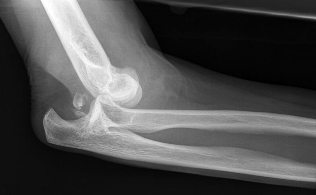 Рентген перелома руки в локтевом суставе