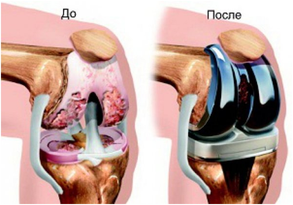 до и после эндопротезирования коленного сустава