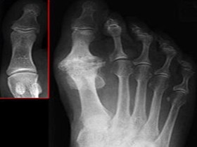 Рентген остеоартроза стопы