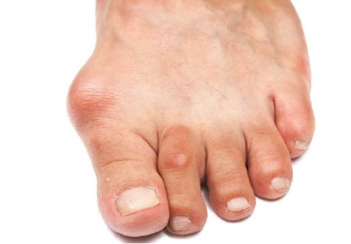 Артроз большого пальца ноги