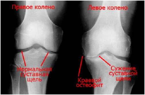 коленный остеоартрит