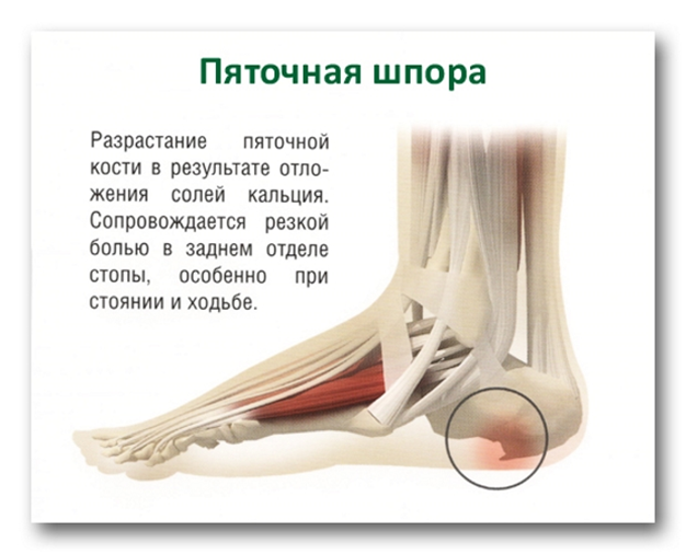 Лечение пяточной шпоры лазером