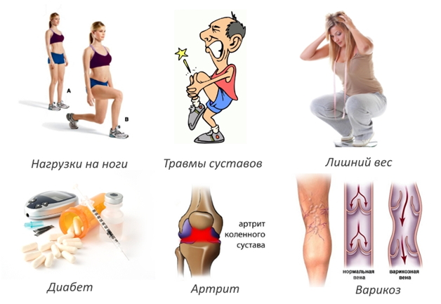 этиология остеоартрита коленного сустава