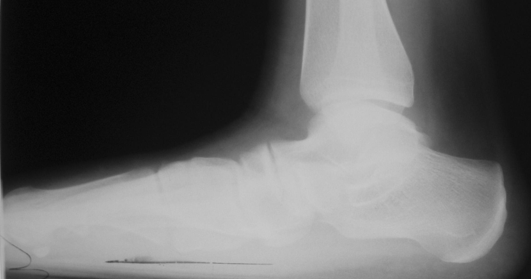 рентгеновский снимок стопы до операции