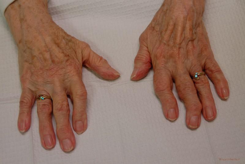 Симптомы остеоартроза периферических суставов