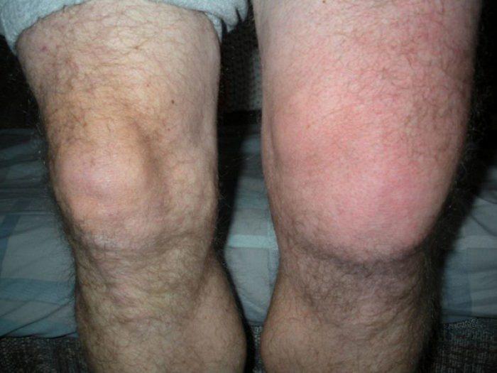 Симптомы поражения колена