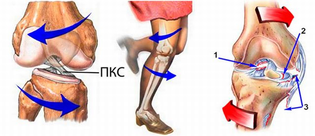 Травма связки коленного сустава
