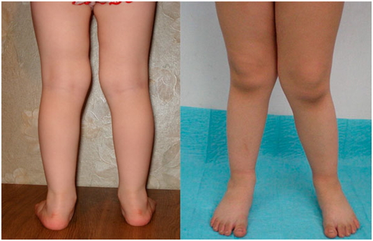 вальгусная дефермация коленных суставов