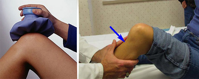 Как лечить разрыв связок коленного сустава