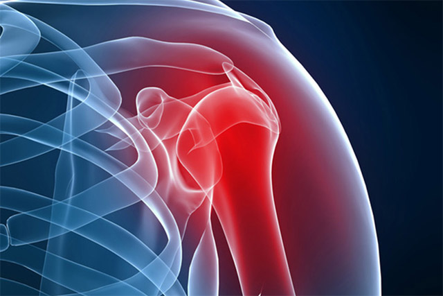 Одна из причин плечевого артроза — острый или хронический артрит