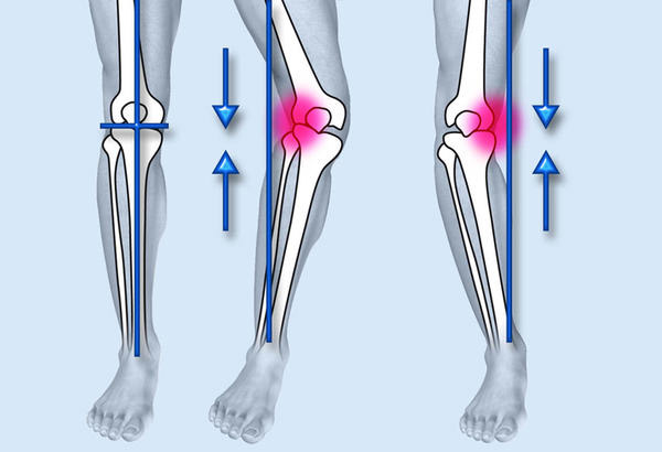 При потере стабильности коленного сустава требуется хирургическая операция