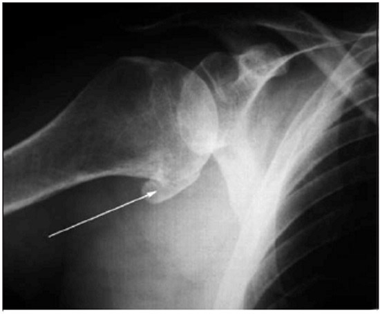 Рентген плечевого сустава — на фото видны остеофиты