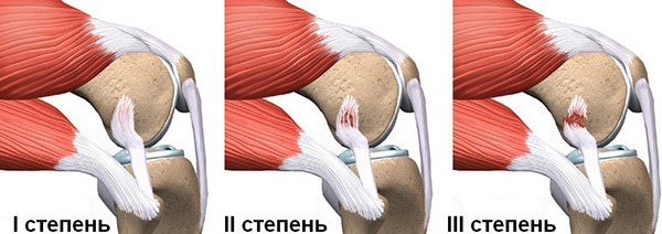 Степени повреждения коллатеральных связок коленного сустава