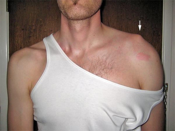 Симптомы привычных вывихов плеча