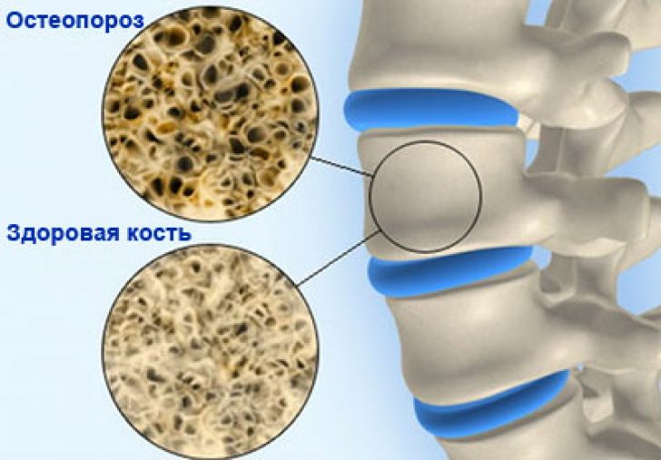 симптоматика остеопороза