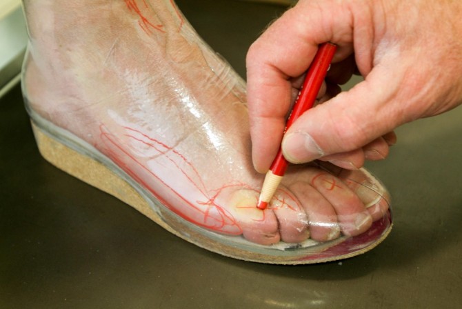 снятие замеров для ортопедической обуви