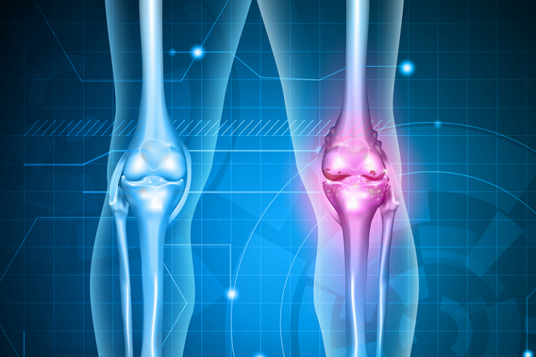 остеопороз коленного сустава