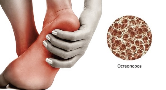 остеопороз стопы