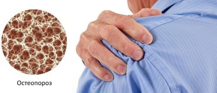 признаки остеопороза плеча