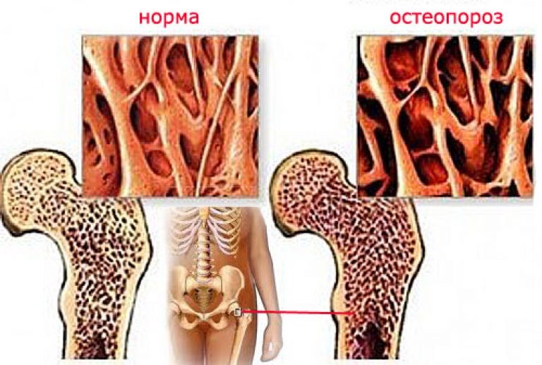 истончение костей при остеопорозе